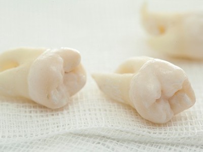 智齒疼了，這牙非拔不可嗎？