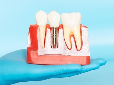 種牙VS鑲牙，你適合哪種?