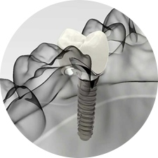 術(shù)前研究、模擬提升種植成功率
