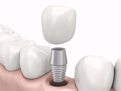 在承德哪家口腔醫(yī)院口腔種植齒好一點(diǎn)，惟德口腔醫(yī)院值得您的選擇