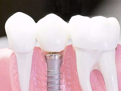 在承德口腔種植齒需要多少錢？惟德口腔一一為您道來