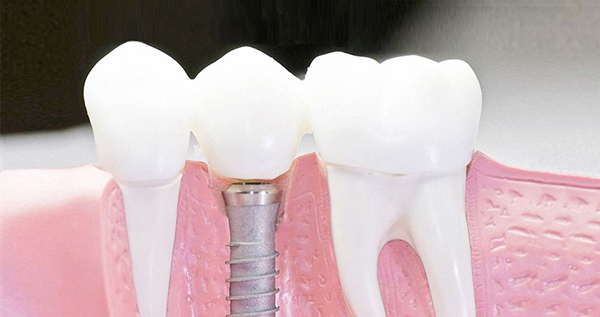在承德口腔種植牙齒需要多少錢(qián)？惟德口腔一一為您道來(lái)